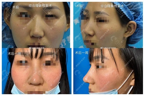 郑大二附院李刚医生做耳软骨隆鼻修复术前术后对比图