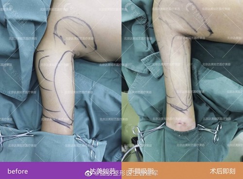 北京达美如艺曹建军院长手臂吸脂术前术后对比图