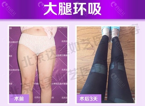 北京达美如艺大腿环吸术前术后对比图