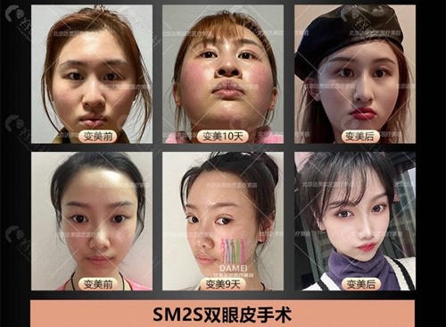 北京达美如艺双眼皮手术术前术后恢复对比图
