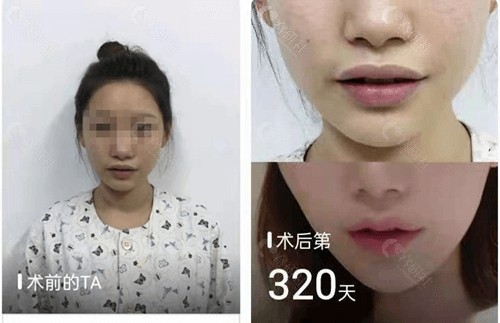 北京清木医疗美容厚唇改薄对比照