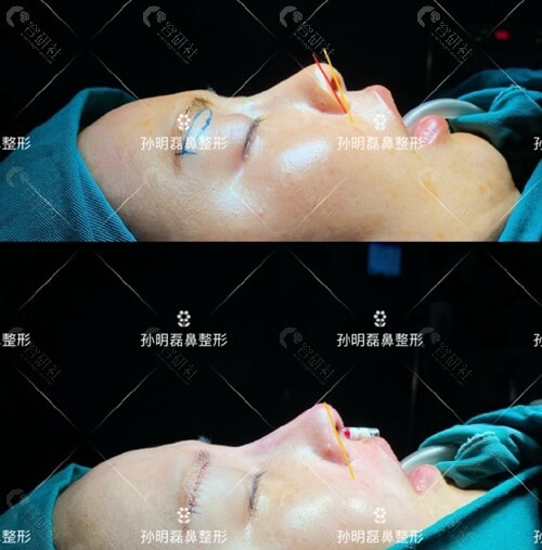 宁波美莱医疗美容隆鼻术后照片