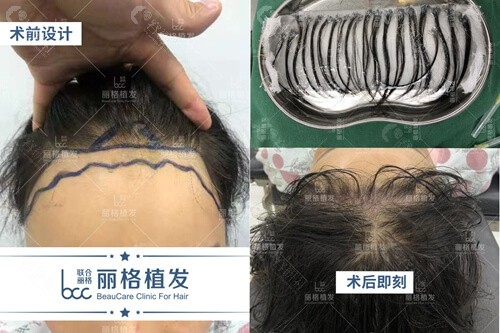 北京联合丽格不剃发植发术后照片
