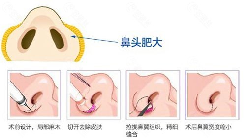 鼻翼缩小方法