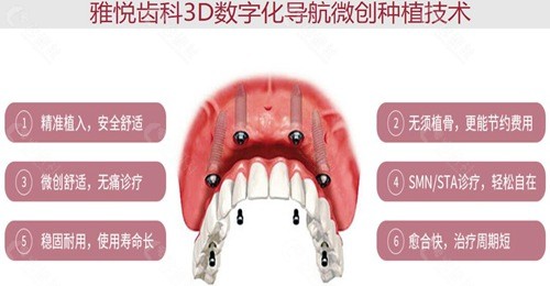 上海雅悦口腔做种植牙技术优势