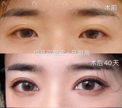 北京华韩医院切开双眼皮+开眼角术前术后对比图