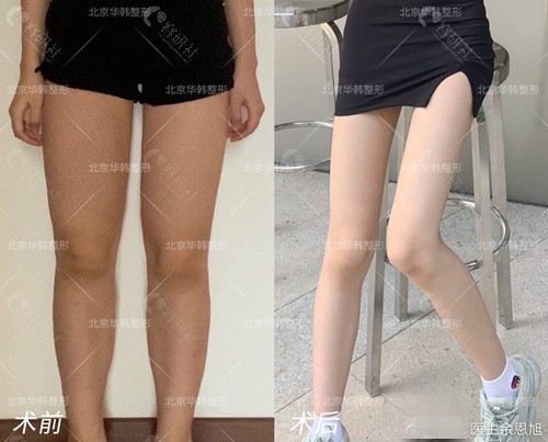 北京华韩整形医院大腿吸脂术前术后对比图