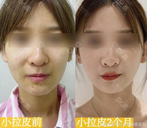 北京华韩整形医院高亚东拉皮除皱术前术后对比图