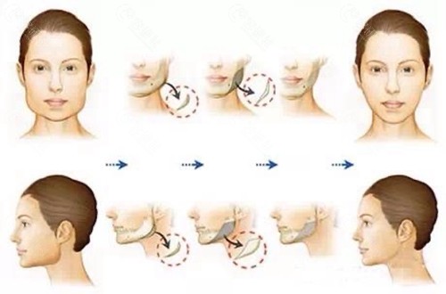 什么原因导致面部松垂，如何预防轮廓手术后面部下垂问题？