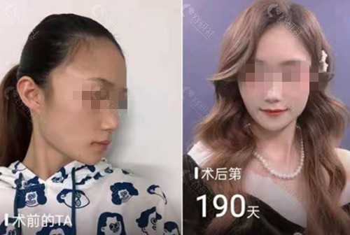 上海新生植发前后对比图