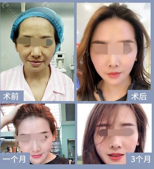 武汉乐美医疗美容面部提升前后对比照
