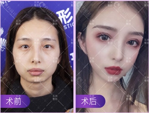 武汉五洲莱美医疗美容面部综合改善前后对比