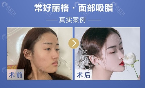 北京常好丽格面部吸脂术前术后对比照分享