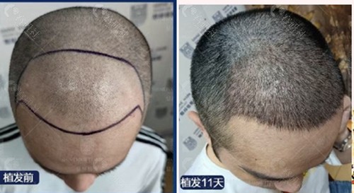 武汉靠谱的植发医院,含新生,熙朵,显赫植发前后对比照