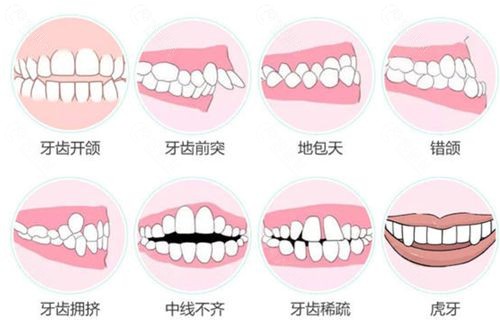 哪种情况下需要做牙齿矫正？
