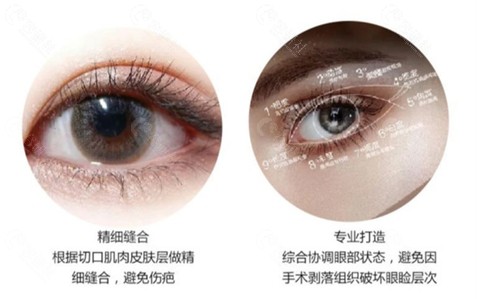 江门梦想医疗美容割双眼皮技术优势