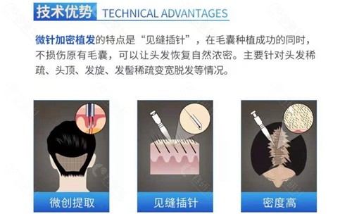 北京大麦微针植发技术优势