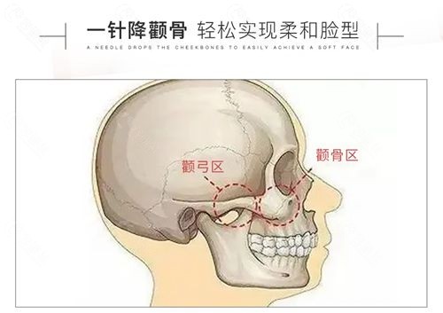 一针降颧骨原理