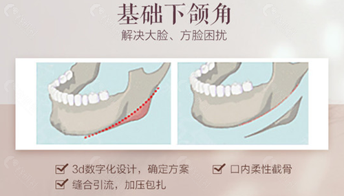 北京圣嘉新下颌角手术优势