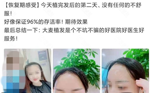 福州大麦微针植发服务好