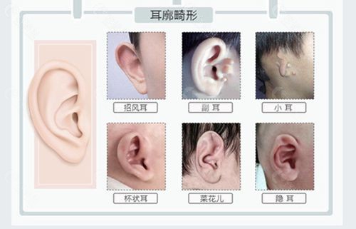 耳朵畸形问题的种类