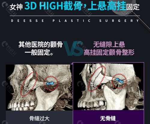 韩国女神轮廓手术技术