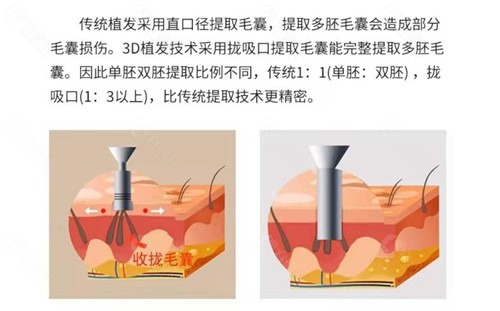 北京新生3D植发技术优势