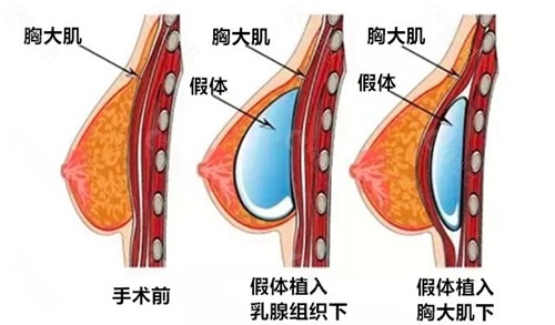 隆胸假体植入层次介绍