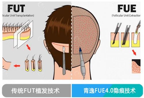 深圳青逸植发植发技术