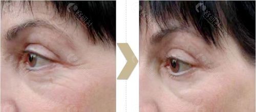 黄金热拉提2.0一次治疗后眼周皱纹明显变淡