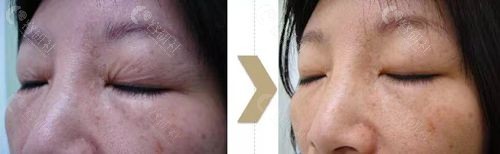 黄金热拉提2.0三次治疗后：眼周皱纹消除