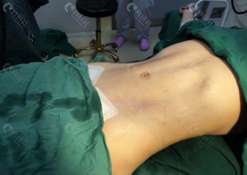 广州韩后医疗美容超脂塑体雕术腰腹环吸即刻图片