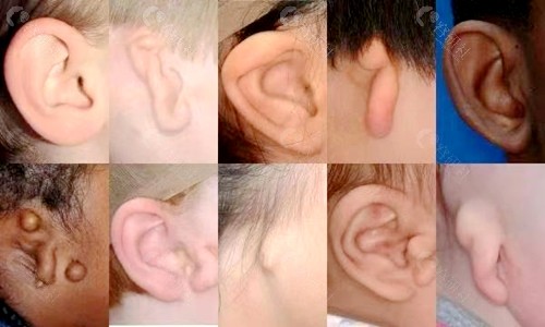 什么是小耳畸形？小耳畸形都有哪些表现？