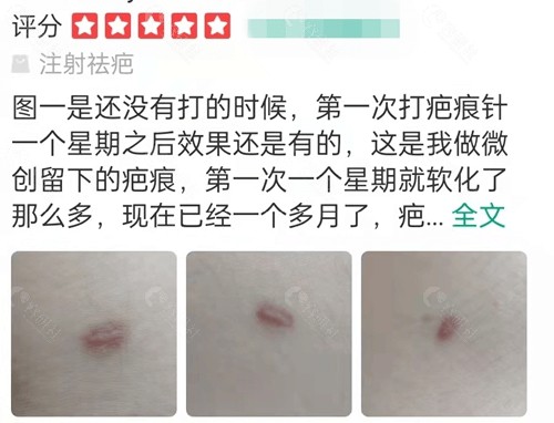 深圳阳光疤痕修复评价