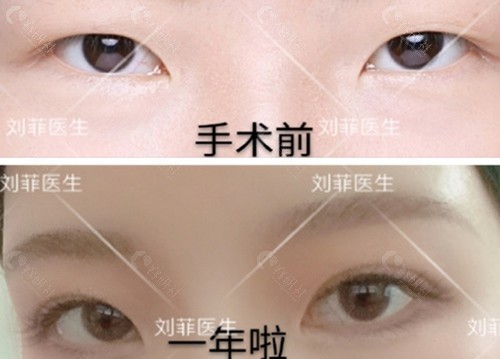 上海九院刘菲双眼皮术前术后对比