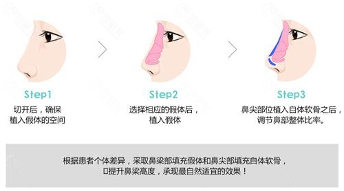 隆鼻方法