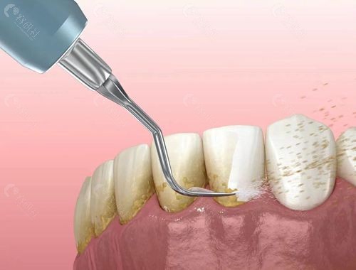 牙医都想揭开的洗牙真相：洗牙会伤害牙齿让牙齿变薄牙缝变大