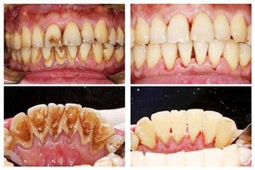 洗牙会让牙齿变得敏感？洗牙前后变化图