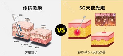 传统吸脂和5G天使光雕区别