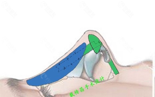 隆鼻手术设计图