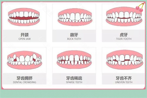 几种需要做牙齿矫正的牙齿问题