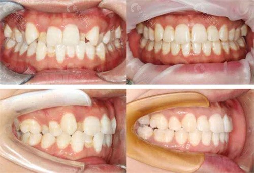 牙齿矫正前后对比照片