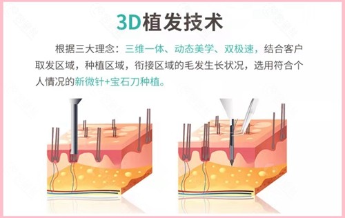 新生植发技术优势