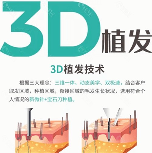 北京新生3D植发技术怎么样