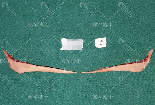 扬州大学附属医院郭军下颌角整形取出骨头展示