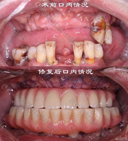 西安存济医学中心口腔种植科穿颧穿翼种植修复后口内情况