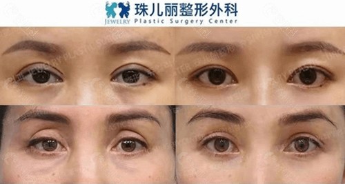 韩国双眼皮修复好的医院