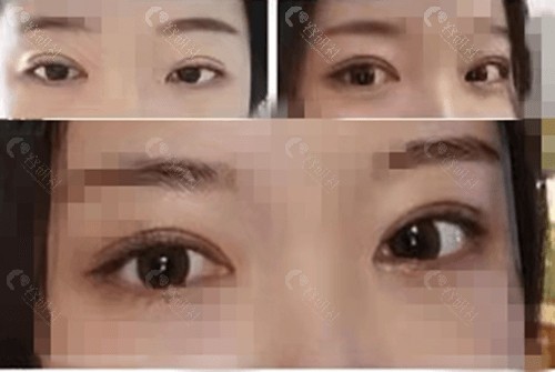 韩国1mm整形外科眼修复怎么样