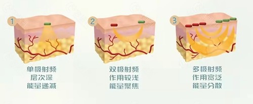 射频仪器的分类