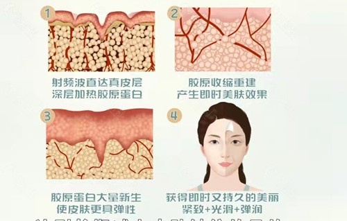 射频紧肤有哪些功效？